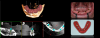 Fig 7. The dots between the arches on a CT scan are reference points for treatment planning to help coordinate the data and visualize the results before laying the foundation.