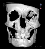 Fig 9. Scanning templates allow alignment of intraoral scans.